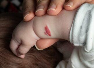 Common baby rashes, spots, and angiomas