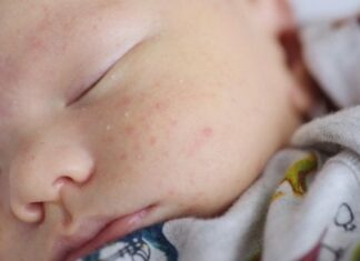 Treatment of cradle cap and neonatal acne